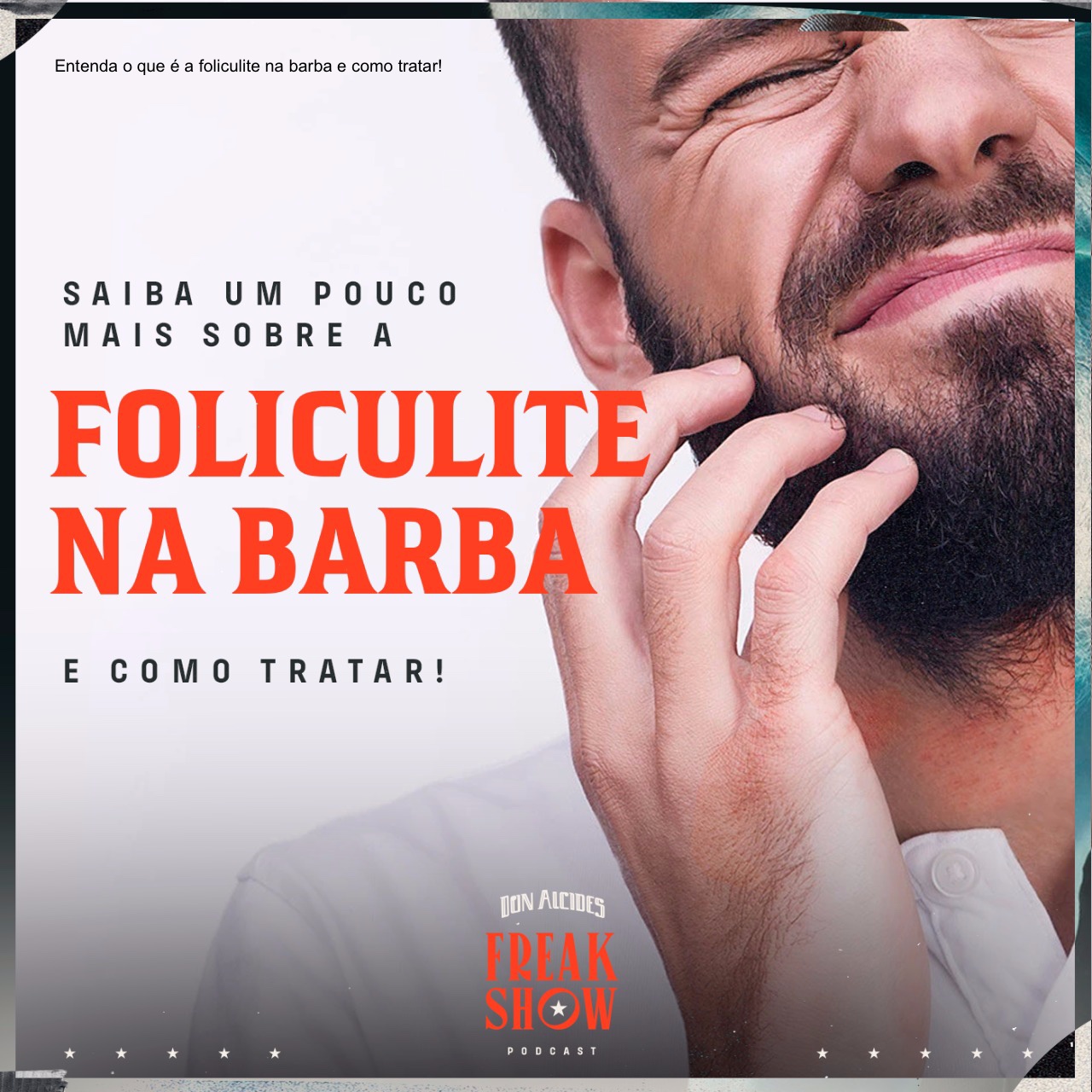 Entenda O Que A Foliculite Na Barba E Como Tratar