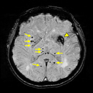 Cerebral Small Vessel Disease