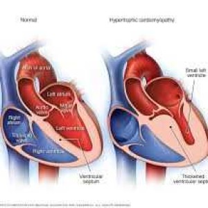 Cardiomyopathy 