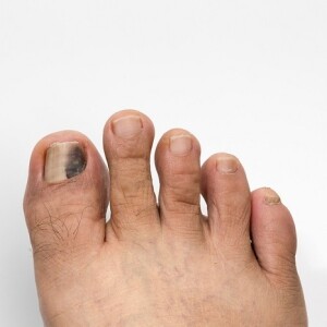 #1 most worrisome problem with toenail lost to running