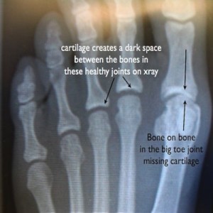 5 changes on X-rays with Hallux Rigidus