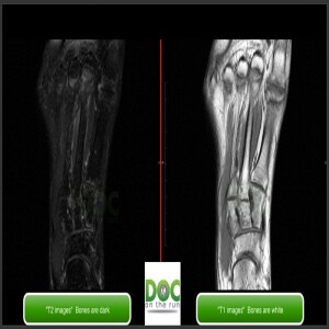 MRI essentials for Runners, T1 vs T2 images