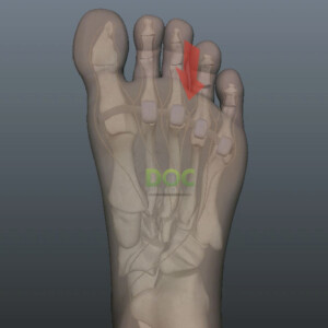 When are x-rays useful for runners with Morton’s neuroma?