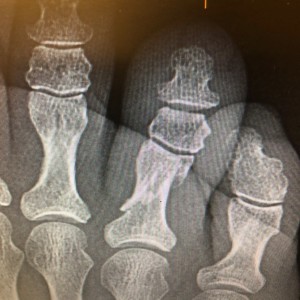 #212 What is a displaced vs non displaced fracture?