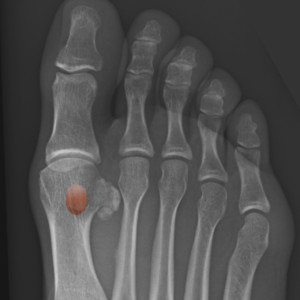 Will a bone stimulator help sesamoiditis?