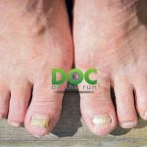 Top 5 Mistakes Runners Make with Their Toenails