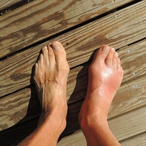 Most ignored part of a gout diet for runners