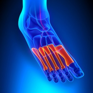 What is a grade 5 metatarsal stress fracture?