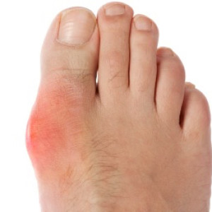 What is capsulitis in the big toe joint