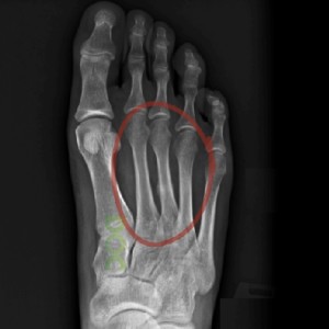 What is periosteal reaction in a stress fracture?
