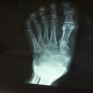 How X-Rays Show Metatarsal Fracture Healing