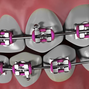 Dental Braces Treatment in Lakewood CA