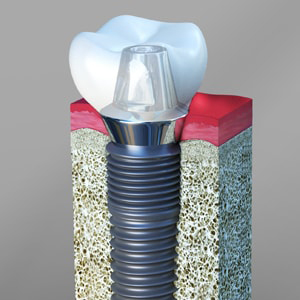 Dental Implants Lakewood CA
