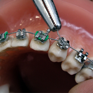 Maintain your oral care throughout orthodontic treatment