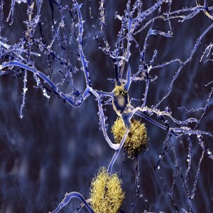 FDA Approves Alzheimer’s Drug Lecanemab… #115