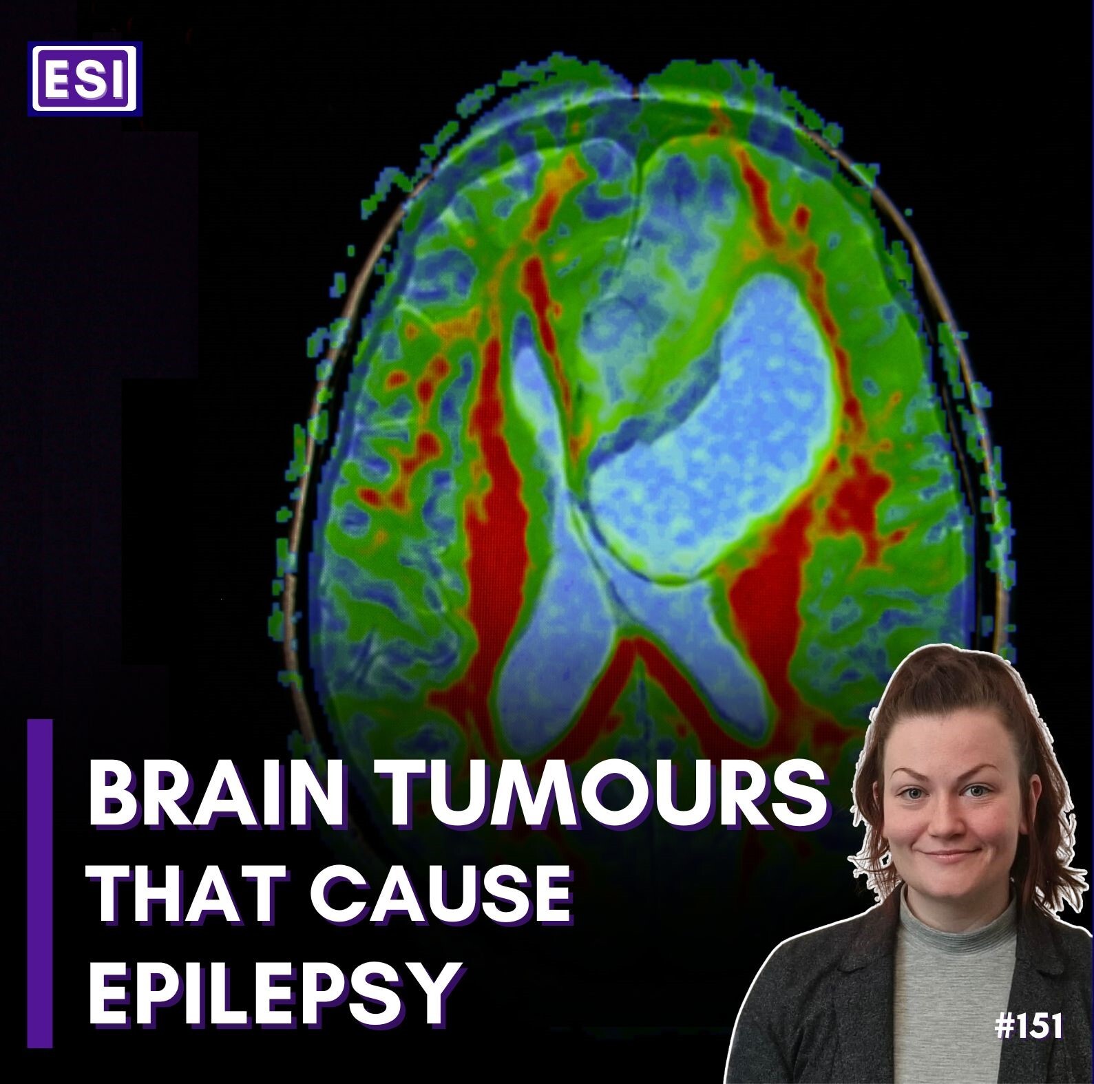 Epilepsy Sparks Insights