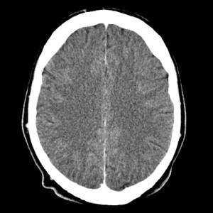 We’re Thinking About It Wrong: The CTA vs. LP Debate for Subarachnoid Hemorrhage