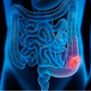 Colon Cancer and CF: Panel (Audio)