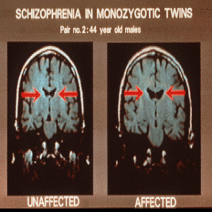 #4 Schizophrenia, 8 Disorders 9/29/14
