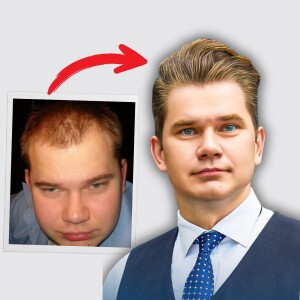 Still Shedding on Finasteride? Here’s Why