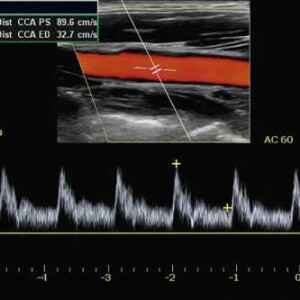 Spectral vs Color Doppler, Artifacts, Wall Filters