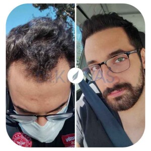 DHI Hair Transplant In Turkey