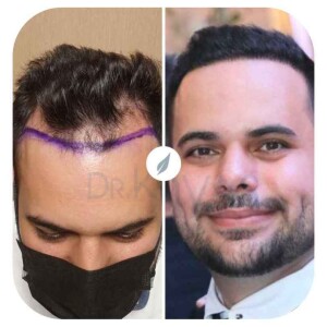 Hair Transplant Costs In Turkey