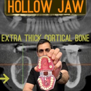 ep 002: Hollow Jaw / Focal Osteoporotic Bone Marrow Defects and How They Affect Dental Implants