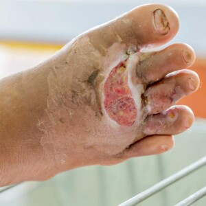 What Does an Infected Cut Look Like? Signs, Symptoms & Pictures