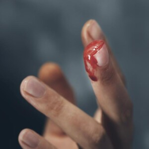 How to Treat a Skin Avulsion Finger Wound: Step-By-Step Guide With Pictures