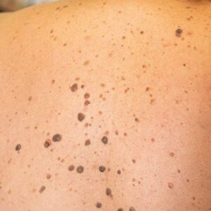 What Are Purpura Simplex Skin Rash and Bruises? Are Purpura Spots Dangerous?