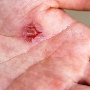 Non-Healing Wounds | Skin Sores, Cuts, Scabs that Won't Heal