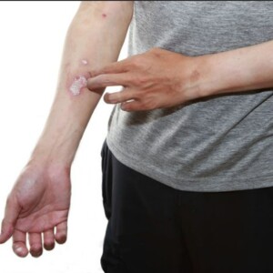 Is Itching a Sign of Wound Healing or Infection?
