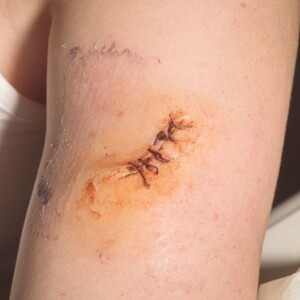 Sutures vs Stitches - Difference Between a Suture & a Stitch