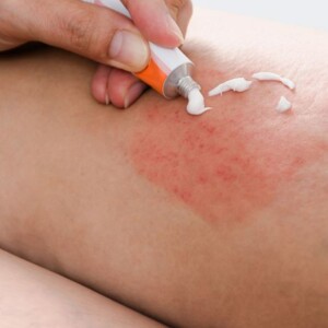 Learn why treating rashes with ointments and creams is essential for adults. Discover effective solutions to soothe irritation, reduce discomfort, and promote healthy skin recovery.
