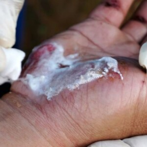 Medline Plurogel: Advanced Burn & Wound Dressing for Healing