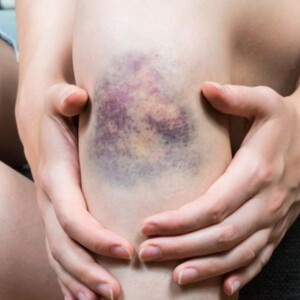 What Are Purple Blotches, Spots and Blood Marks on Skin?