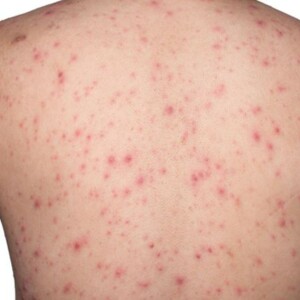 Discover the Difference Between Ecchymosis vs Petechiae