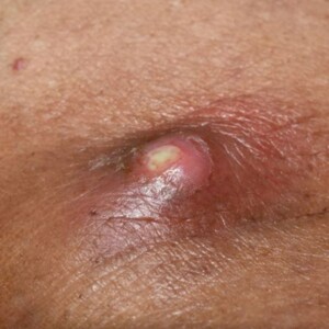 Why Do I Keep Getting Abscesses? Discover Why