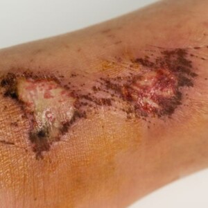 4 Stages Phases and Steps of a Healthy Normal Healing Wound