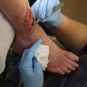Venous Insufficiency Leg Ulcer ICD-10, Causes & Pictures – Learn the ICD-10 code, characteristics, and causes of venous leg ulcers with images for better identification and treatment.