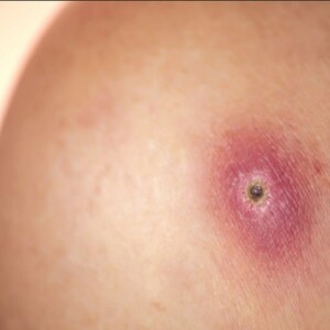 Small Scabs and Skin Sores That Won’t Heal | Causes & Treatment – Learn why some wounds won’t heal and discover effective treatments to speed up recovery.