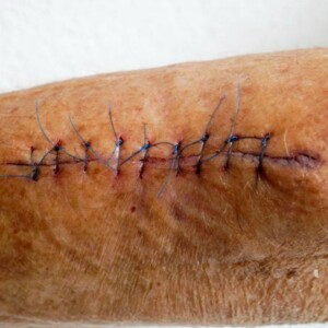 Types of Basic Suturing Techniques & Patterns | PPT & PDF Guide – Learn essential suturing methods with downloadable PPT and PDF resources for easy learning.
