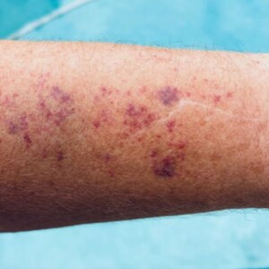 Petechiae vs. Purpura vs. Ecchymosis | Key Differences Explained – Learn how to identify these skin discolorations, their causes, and what they mean for your health.