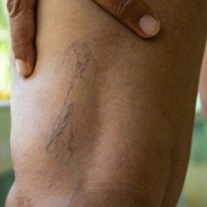 Do Blood Clots Look Like Bruises? | How to Tell the Difference – Learn how to distinguish between blood clots and bruises, their symptoms, and when to seek medical attention.