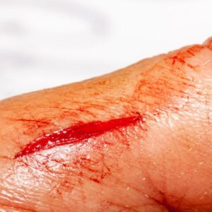 How Long Does It Take for a Laceration Wound or Deep Cut to Heal? – Learn the healing stages, recovery time, and factors that affect wound healing.