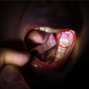 Pediatric Infant & Child Abscess on Gum Near Tooth | Pictures & Treatment – Learn the causes, symptoms, and treatment options for gum abscesses in infants and children with images.