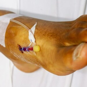 What Is the Fastest Way to Heal a Leg Ulcer? | Expert Tips – Discover the best treatments, wound care practices, and lifestyle changes to speed up leg ulcer healing.
