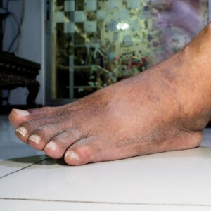 Peripheral Artery Disease in the Black Community: Signs, Causes, and Treatment