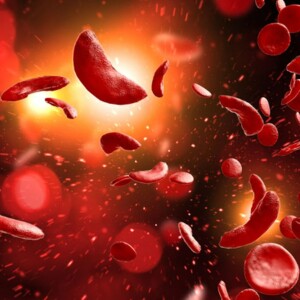 Difference Between Sickle Cell Anemia & Sickle Cell Disease